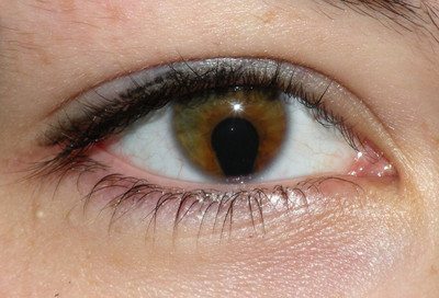 Coloboma - © Attention Deficit Disorder Prosthetic Memory Program