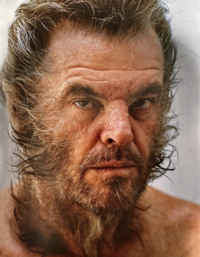 Hypertrichosis - © Attention Deficit Disorder Prosthetic Memory Program