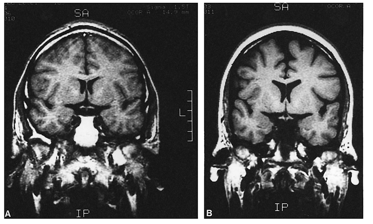 Selective Amnesia | Attention Deficit Disorder Prosthetic Memory Program