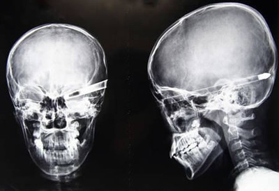 X-Ray Oddities - © Attention Deficit Disorder Prosthetic Memory Program