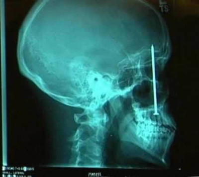 X-Ray Oddities - © Attention Deficit Disorder Prosthetic Memory Program